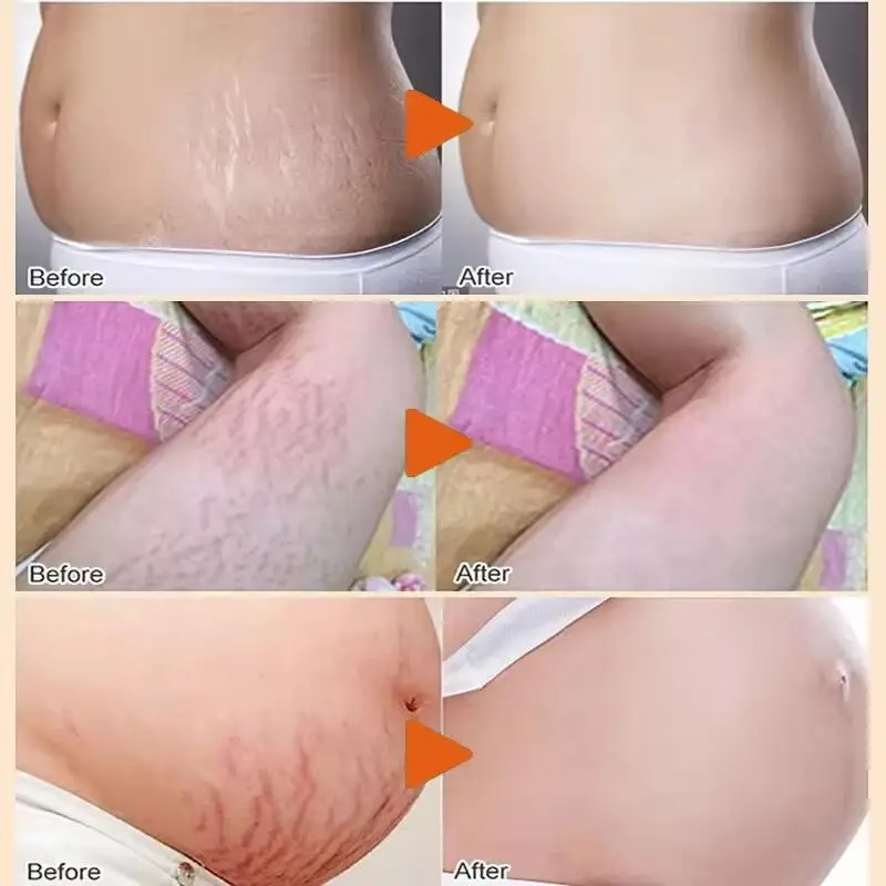 Anti Stretch Marks Cream Removal Stretch Mark Remove Postpartum Obesity Pregnant Stretch Mark Lotion Women Repair Firming 50g