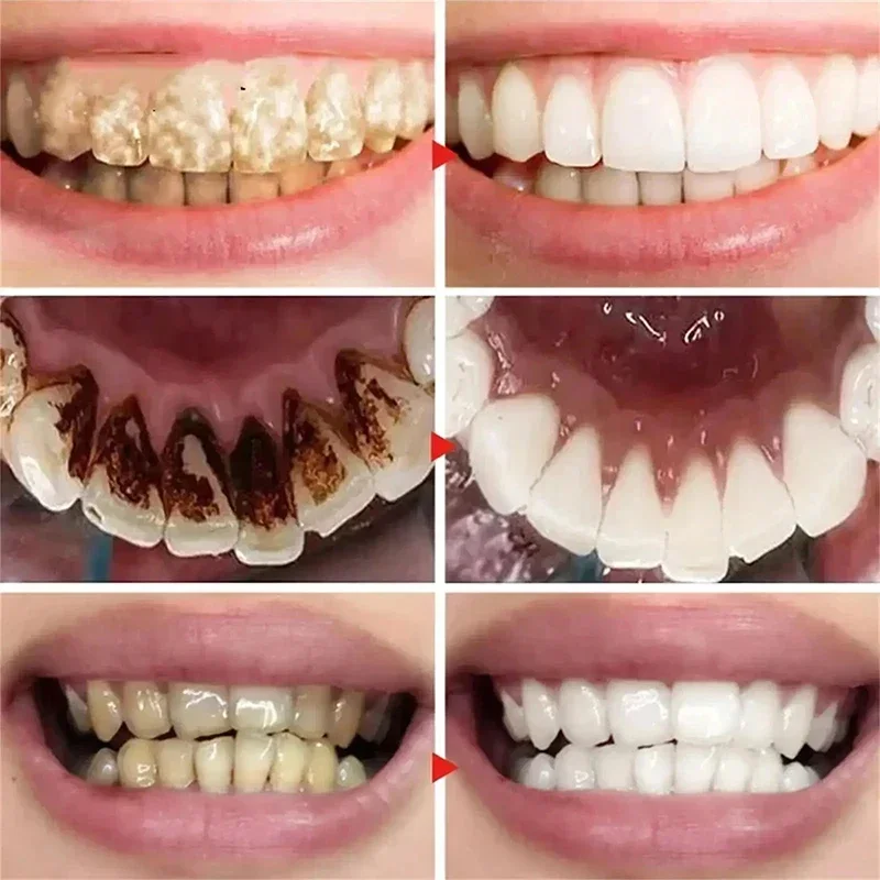 Dentífrico clareador dentífrico V34, bastão 5d, higiene oral, ferramenta de limpeza, hálito fresco