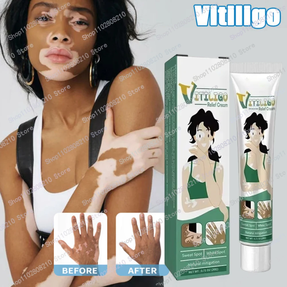 

Organic Vitiligo Treatment With Herbal Extract for White Spot Ringworm Removal