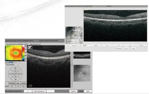SHTOPVIEW الجزء الخلفي للعين OCT التصوير التوافق البصري مع Retiview الكمبيوتر المدمج 500