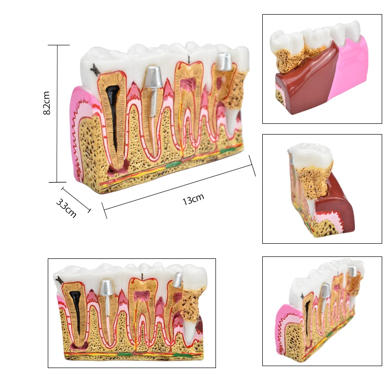 

4X Dental Caries Anatomy Comprehensive Pathology Tooth Nerve Tooth Model for Oral Teaching Teeth Model