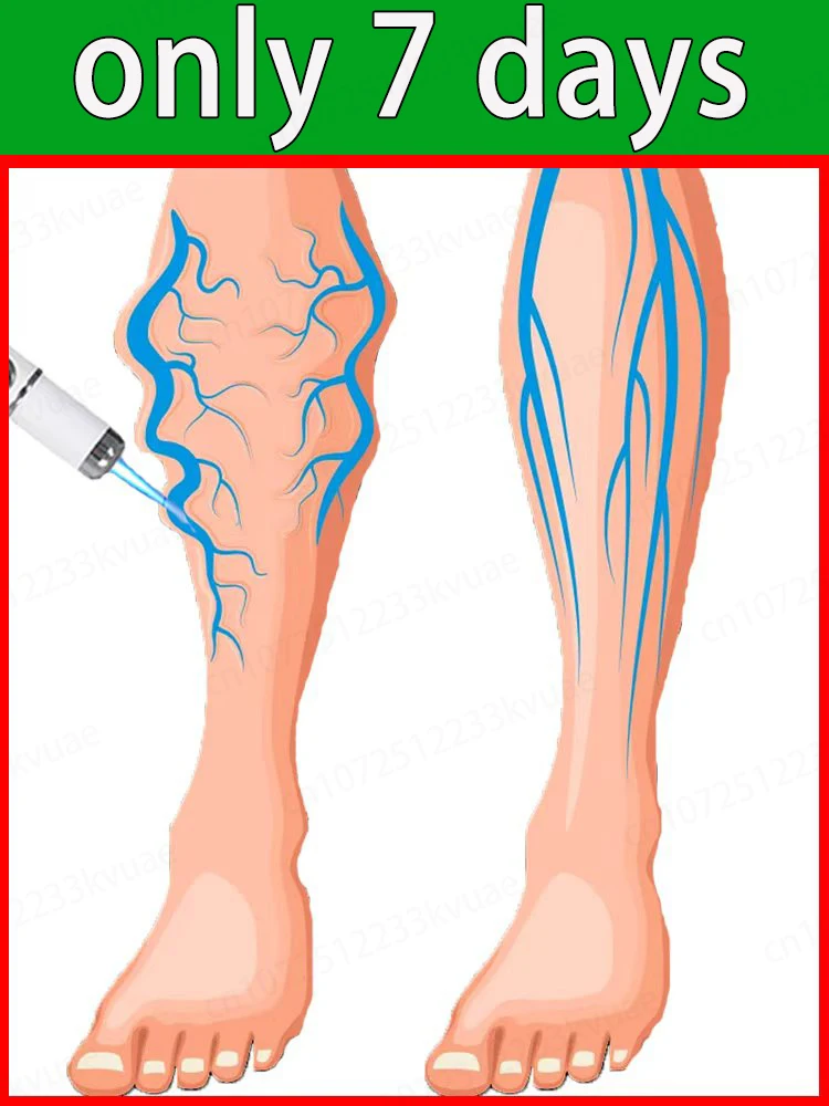 

Generation-8 Laser Says Goodbye To Spider Legs Varicose In 3 Days