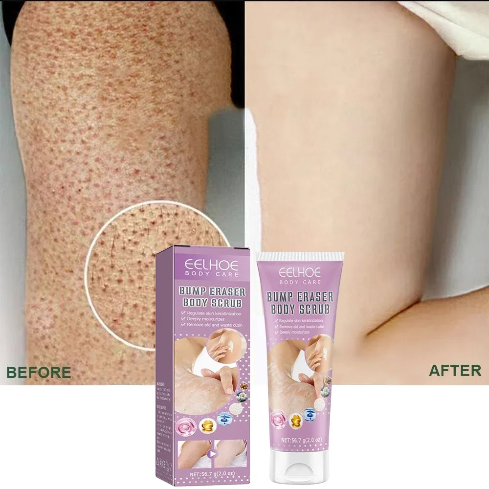 7-Day Fast Body Scrub Cream Moisturizing Skin Repair Keratosis Pilaris Removing Strawberry Legs Eraser Nourishing Body Skin Care