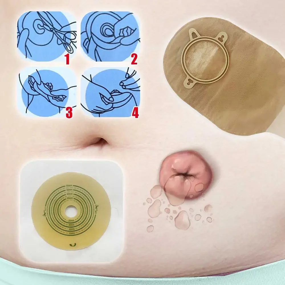 Colorectal Stool Bag Ostomy Supplies Colostomy Bags Two Piece Drainable Pouches with Hoop and Look Ileostomy Stoma Care Supplies