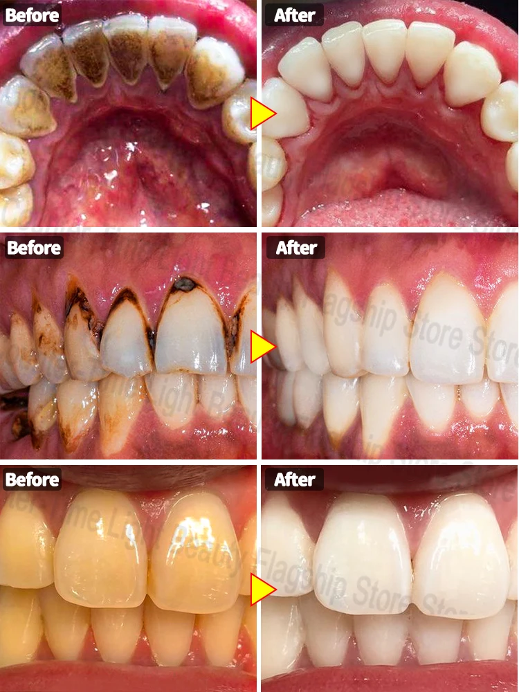 Get white, sparkling teeth fast！
