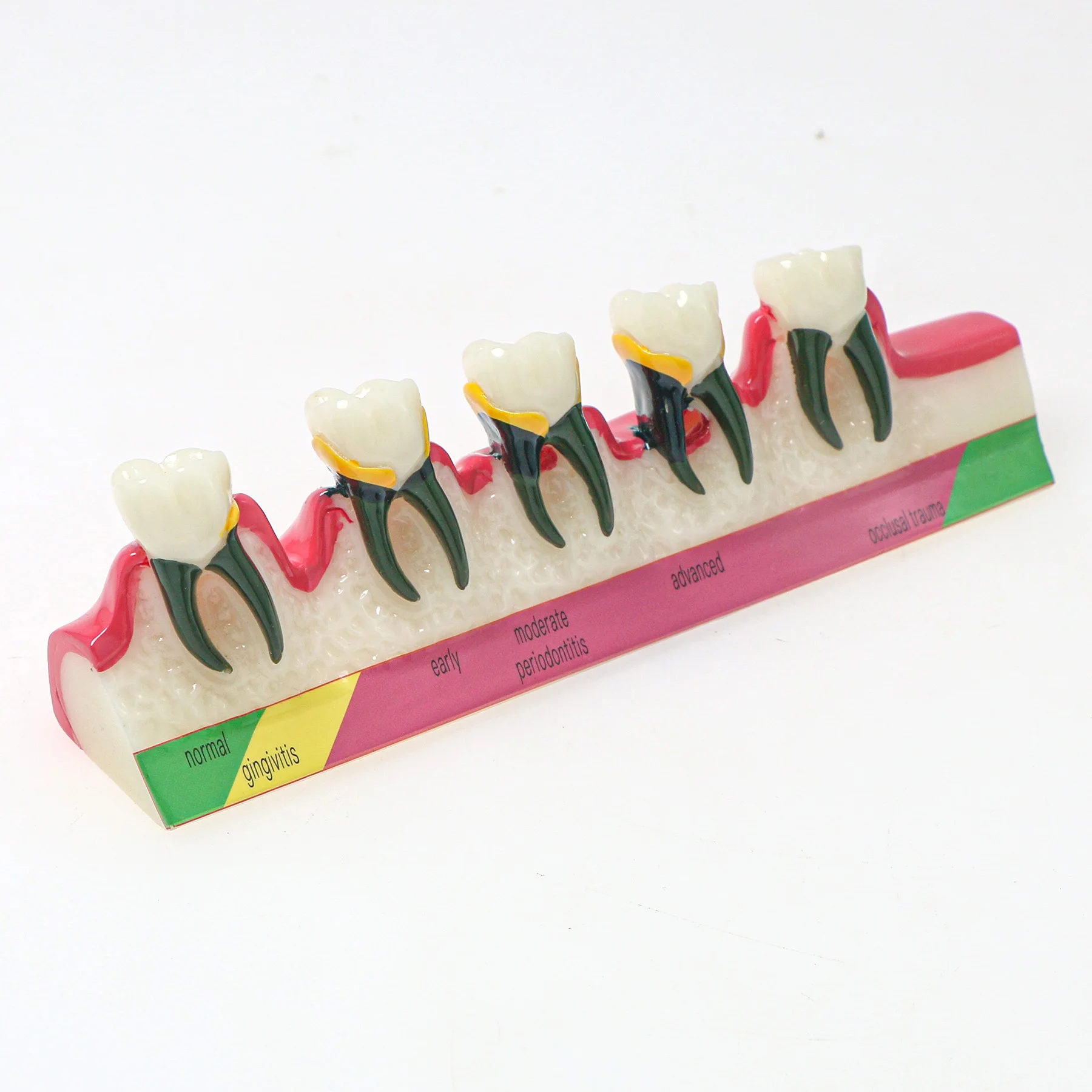 Dental Periodontal Disease Model M4029 Typodont Teeth Disease Demo Teaching Model Caries