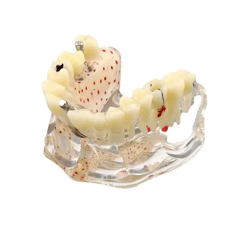 Dental Anatomical Tooth Model M2007 Implant Practice Model Bone Matrix Caries Be In Hot Sale