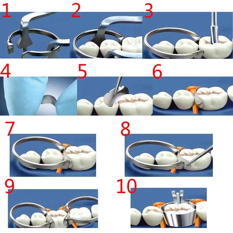 100 Uds. Matrices metálicas contorneadas seccionales de matriz Dental No.1.398 lmws 2 anillos