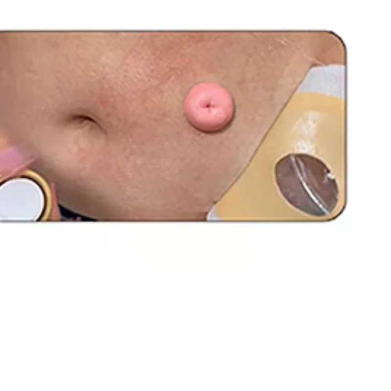 

1 Pcs 15ml Colostomy Adhesive Wipe-Off Spray Ostomy Adhesive Stripping Spray Medical Adhesive Remover Ostomy Bag Care Products