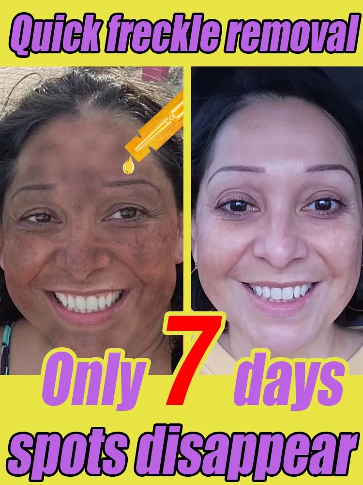 Facial freckles disappear in 7 days