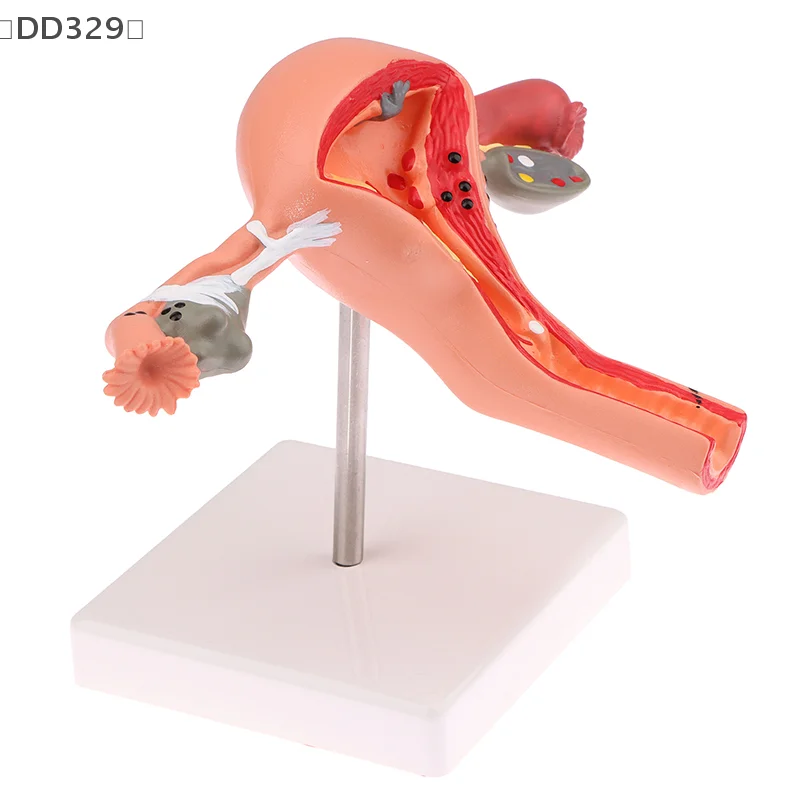 〔DD329〕1Pcs Medical Props Model Pathological Uterus Ovary Anatomical Model Anatomy Cross Section Study Tool