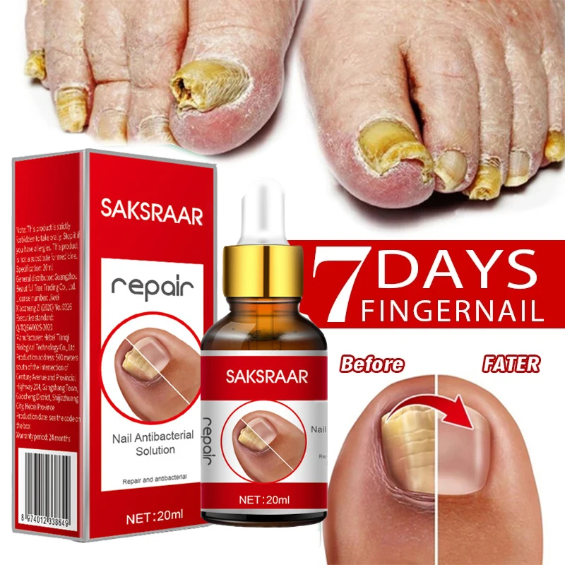 Nail Fungal Treatment Feet Care Essence Nail Foot Whitening Toe Nail Fungus Removal Gel Anti Infection Paronychia Onychomycosis