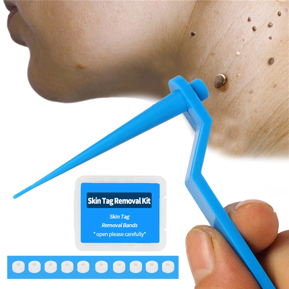 Indolor Segurança Pele Ferramenta De Remoção Tag Mole verruga Remover Ferramenta Para Pequeno A Médio SkinTag Kit De Remoção