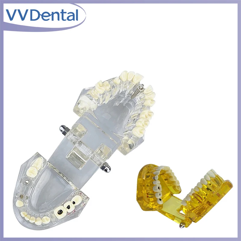 

Dental Disease Teeth Model For Medical Science Dental Disease Teaching Study Model With Restoration Bridge Tooth
