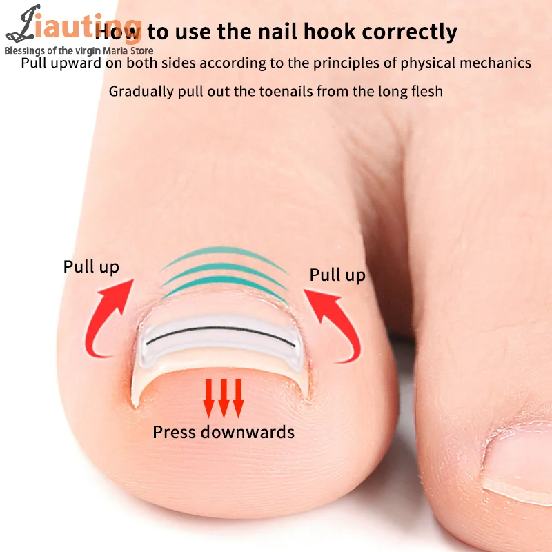 2Pcs Nagel Korrektur Aufkleber Eingewachsene Zehennagel Corrector Patches Paronychie Behandlung Erholen Corrector Pediküre Werkzeuge Fuß Pflege