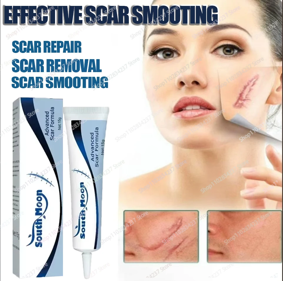 Acne Scar Stretch Marks Remover Cream Postoperative scar repair Skin Repair Acne Black Dots Spots Acne