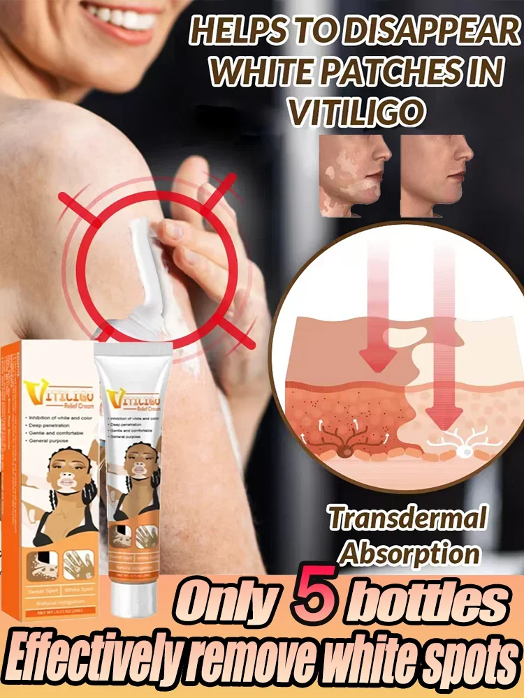 ⁿⁱᶜᵉ Eliminate Vitiligo cream Skin soothing White Spot Removal vitiligo ointment Eliminate pigment