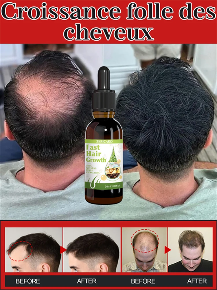 99% of buyers buy again, have more and more hair, say goodbye to baldness, thick hair,Hot selling product