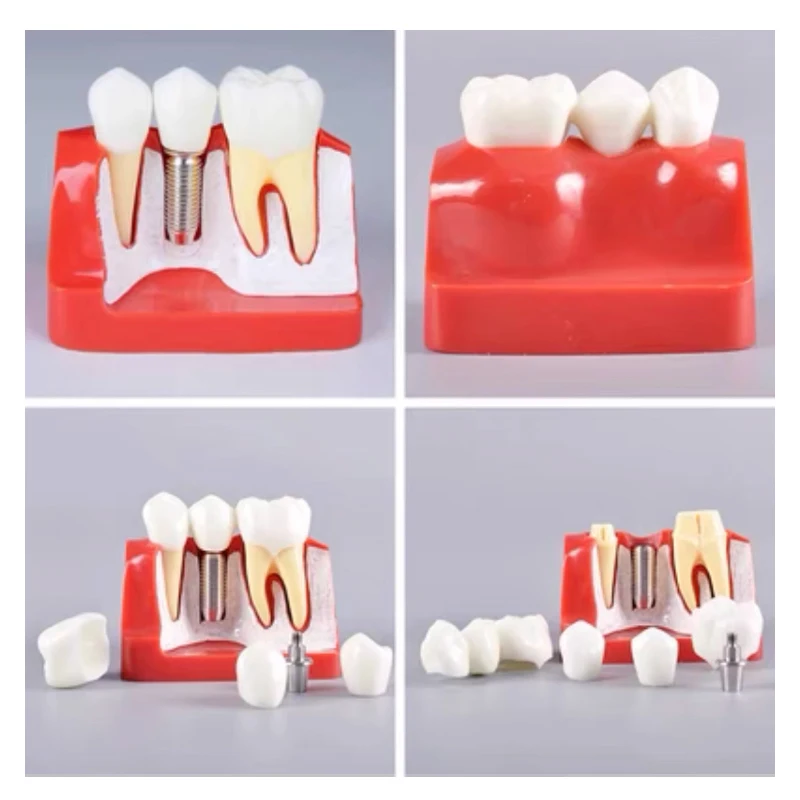 Big Sale Dental 4 Times Teeth Model With Removable Implant Analysis Crown Bridge Dental Implant Teaching Demonstration Model