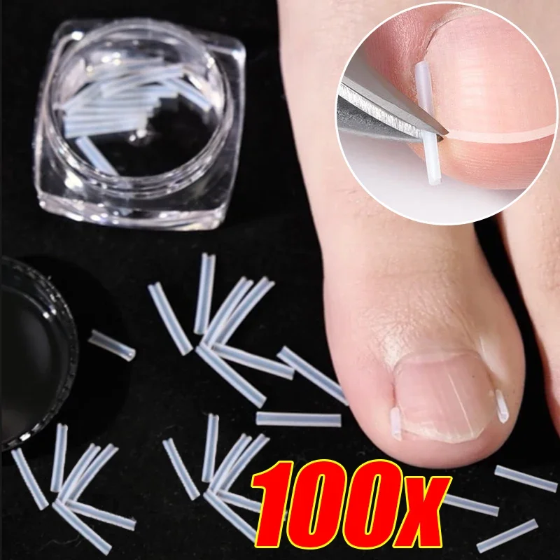 1-10 caixa elástica em forma de c tubo estofamento tratamento cuidados com os pés invisível sulco alisamento clipe encravado ferramentas corretor de unhas