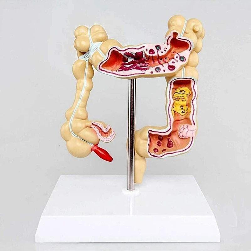 Colon Pathological Colorectal Cancer Model Large Intestine Model Gastrointestinal Anatomical Model