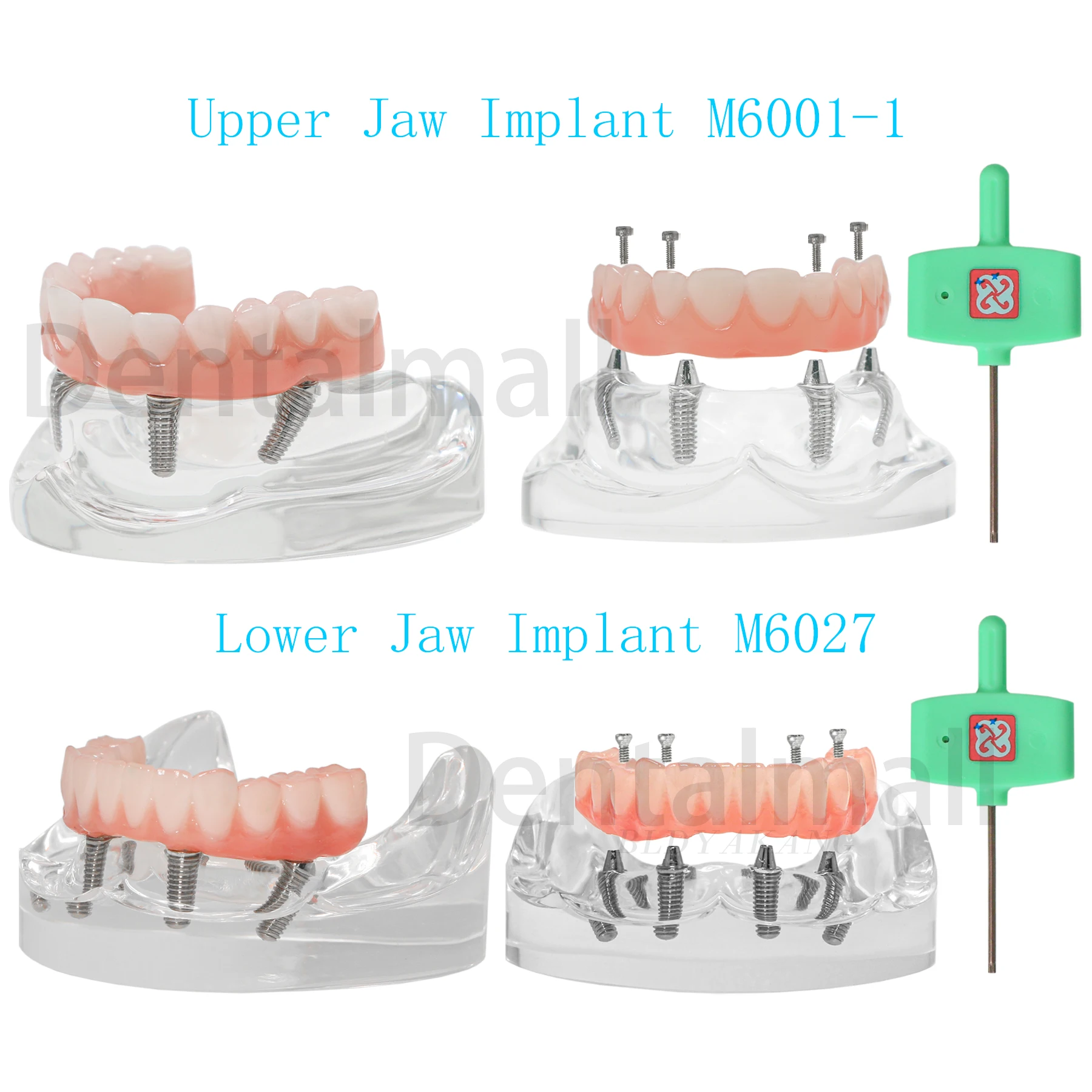 Implants Teeth Model Upper/Lower Jaw 4 Removable Screws Demo Implant Restoration Overdenture