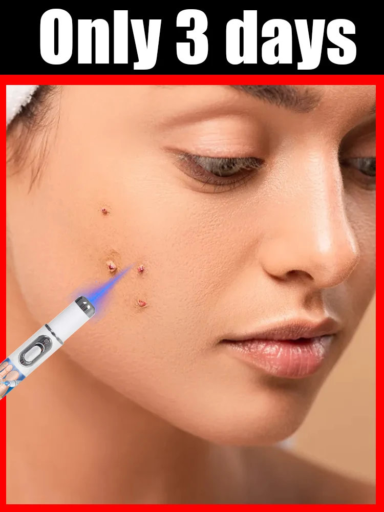 Caneta verruga limpa verrugas da pele, luz azul resolve todas as marcas de pele e partículas gordas