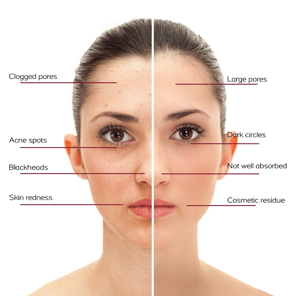 100/200 قطعة إزالة الوشم بالليزر الجلد ثؤلول العلامة قلم بلازما إبرة مخصصة استبدال الإبر لآلة إزالة النمش بالليزر