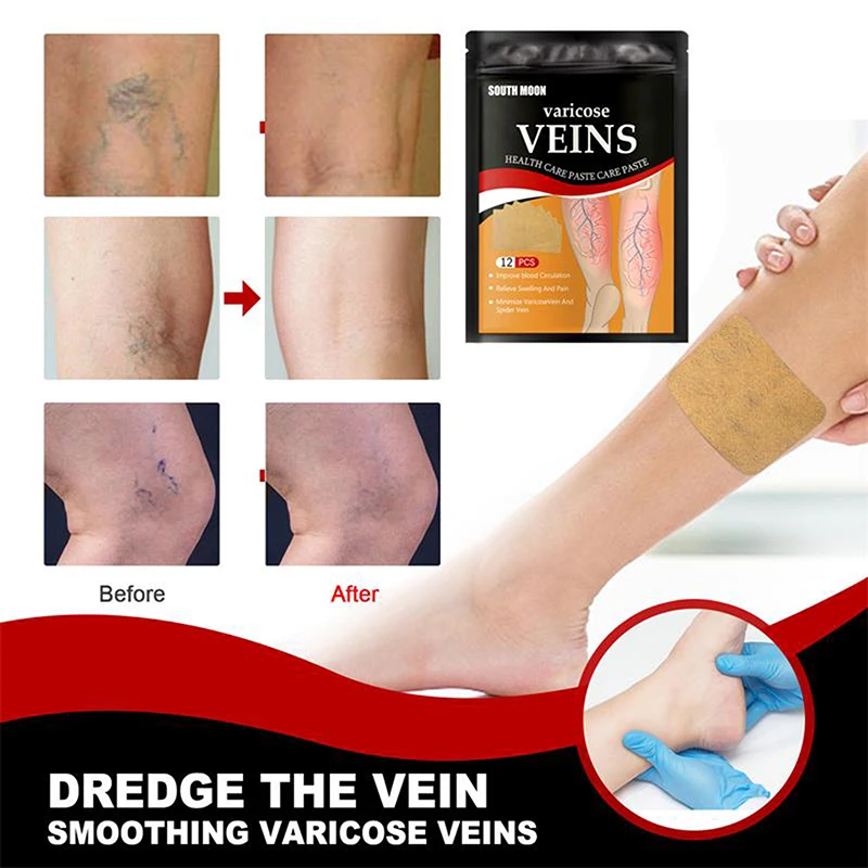 12 PCS/Bag Unisex Varicose Veins Treatment Patch Legs Sore Swelling Plaster Promote Metabolism Promote Smooth Blood Circulation