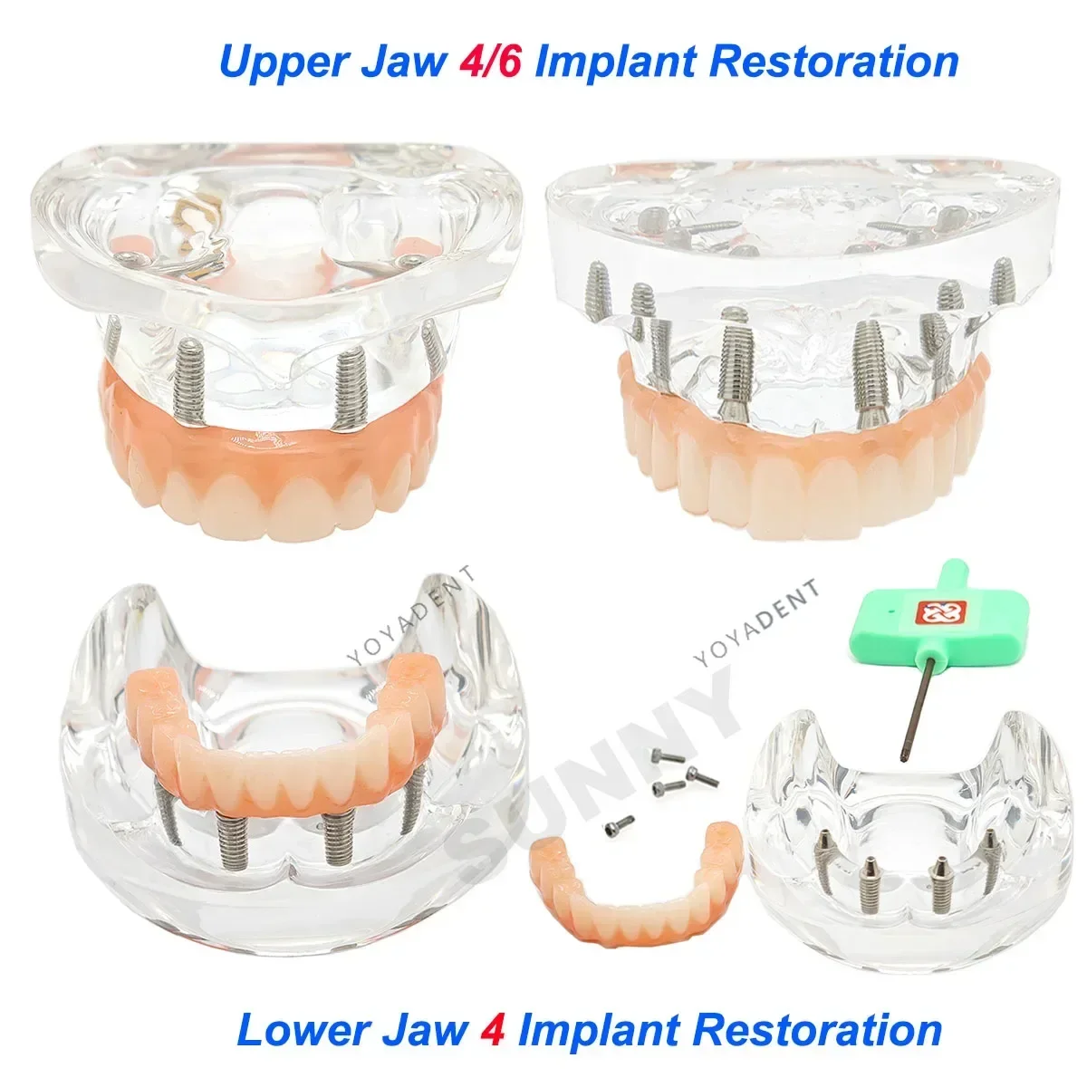 

Dental Teeth Model simulation Transparent Upper Lower Jaw 4/6 Implant Restoration Screws with Post Core Bridge Dentist Teaching