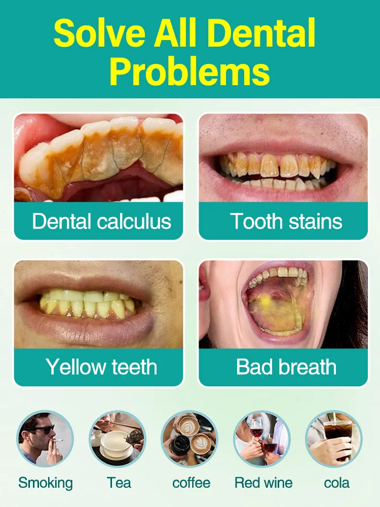 Removedor de cálculo dental, clareamento dos dentes, remoção de odor da boca, mau hálito, prevenção da periodontite