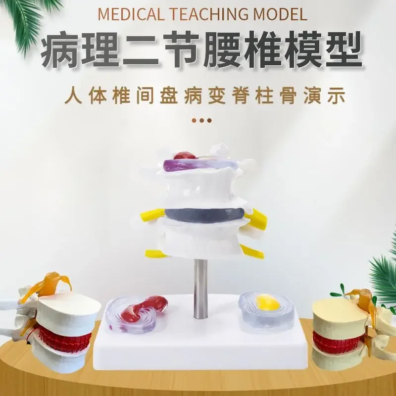Human Lumbar Disc Demonstration Model Lumbar  Spine  Spine  Joint  Medical Teaching