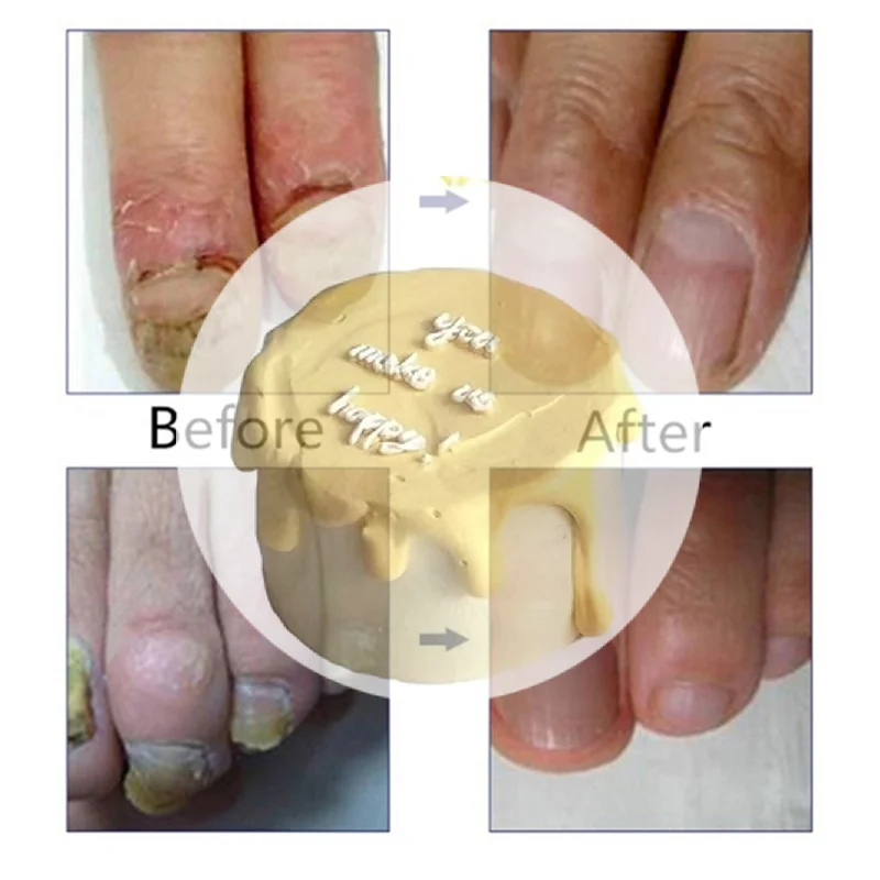 (HS) قطعة واحدة 10 مل للعناية بالبشرة الصحية وإصلاح الأظافر ومنظف سائل لإزالة فطار الأظافر