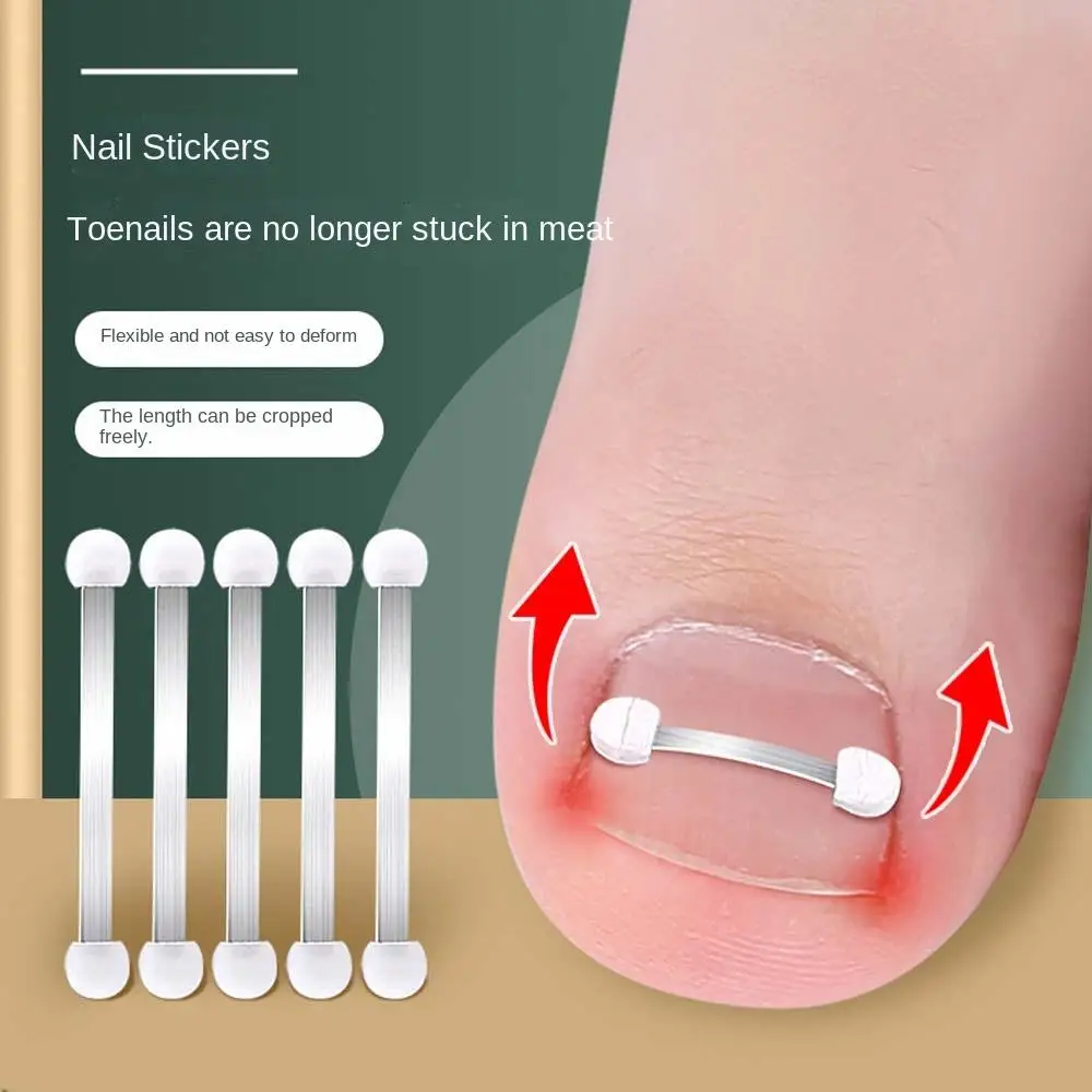 

Toe Braces Pedicure Tool Ingrown Toenail Recover Ingrown Toenails Corrector Bunion Corrector Toenail Straightener Toenail Fixer