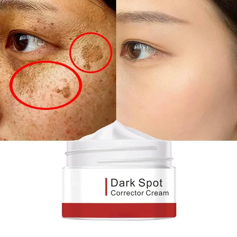 

Effective Whitening Freckle Cream Remove Melasma Acne Spot Pigment Melanin Dark Spots Pigmentation Moisturizing Gel Skin Care