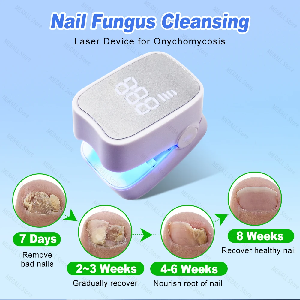 Nail Fungus Laser Treatment Device Repair Effectively Remove Nail Fungal Infection Anti-Equipment Nail Fungus Treatment Tools