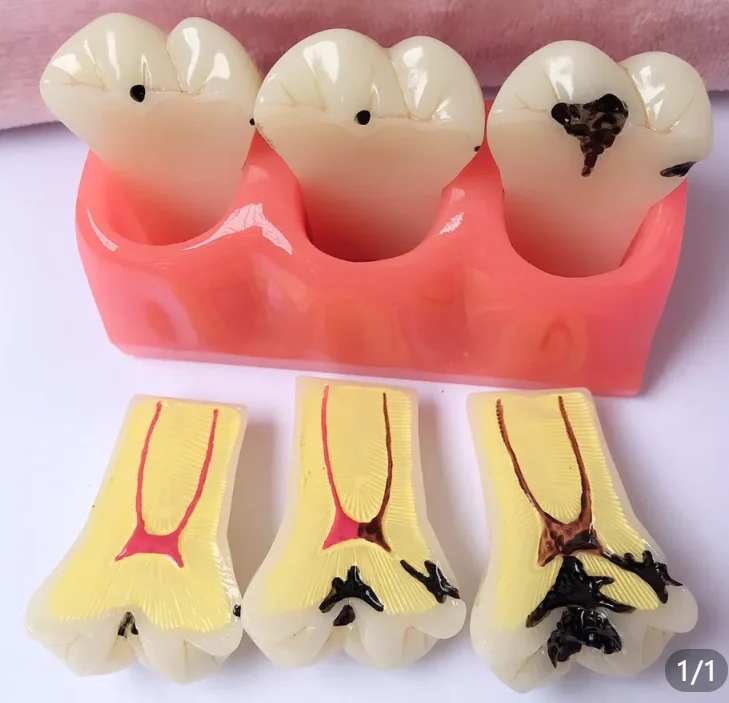 

Dental Caries Tooth Model Caries Anatomy Dental Care Teeth Model Decay Teeth Comparative Education Dental Model