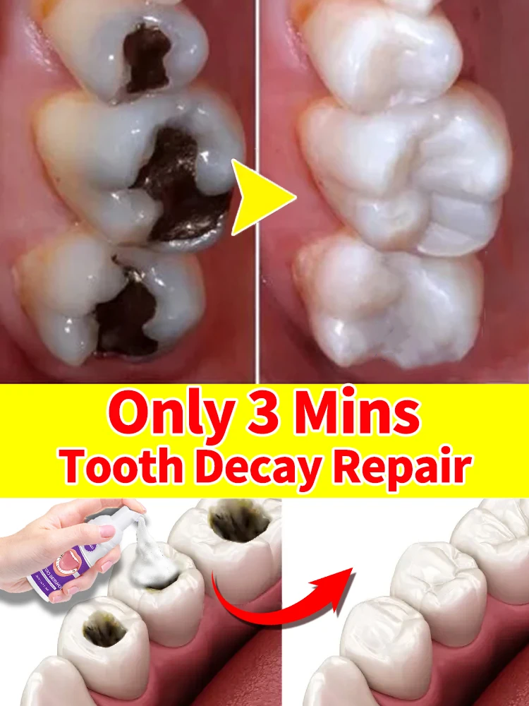 

tooth decay repair repair tooth decay cavities tooth repair treatment