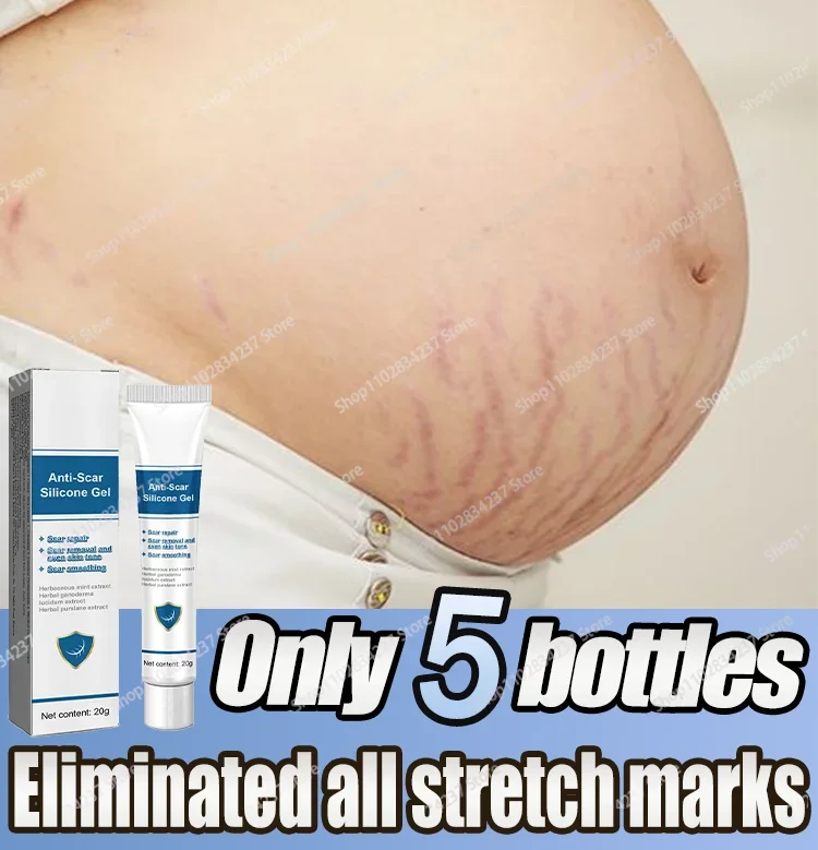 Stretch Mark Removal Postpartum Repair Of Fat Marks On Thighs