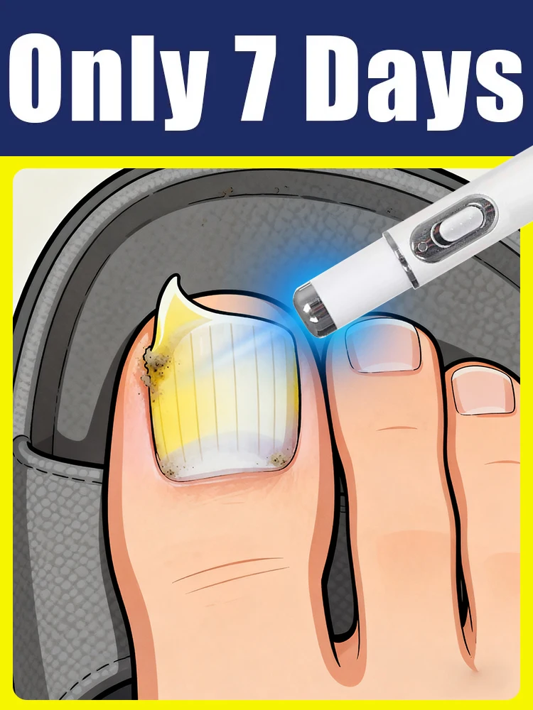 

nail fungus blue light tool, more discounts on sets