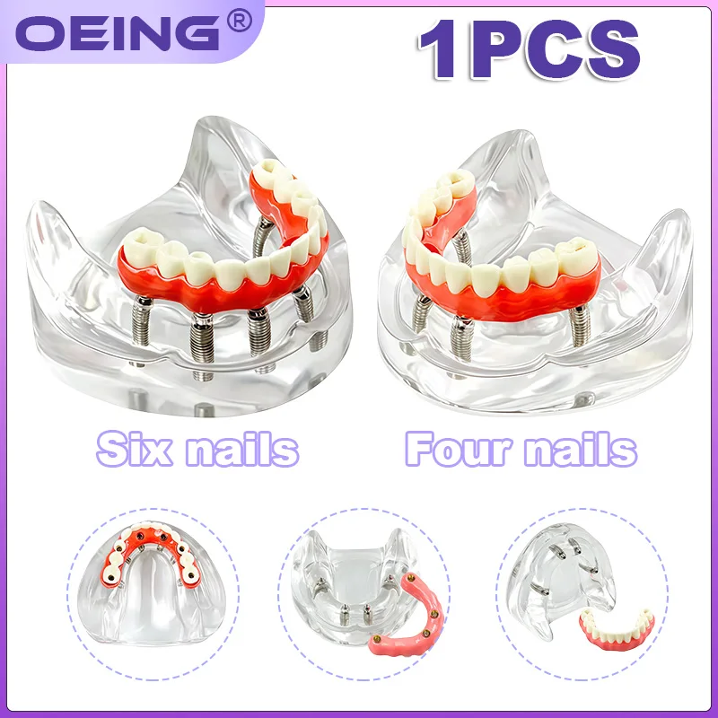 

1 шт. Стоматологическая модель имплантата 4/6, для восстановления зубных протезов, съемная, для обучения в стоматологии, материалы для общения между врачом и пациентом