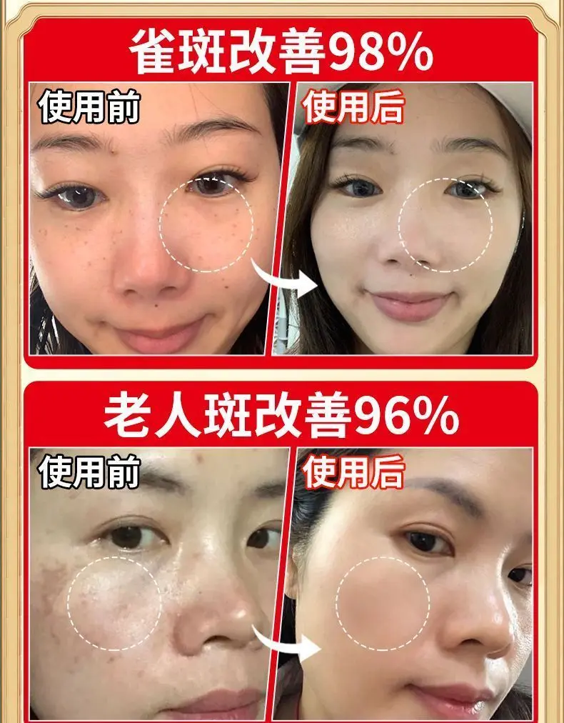 

Age Spot Eraser Cream | Clinic-Inspired Formula for Melasma, Sun Spots & Hyperpigmentation | Brightening + Correcting Complex