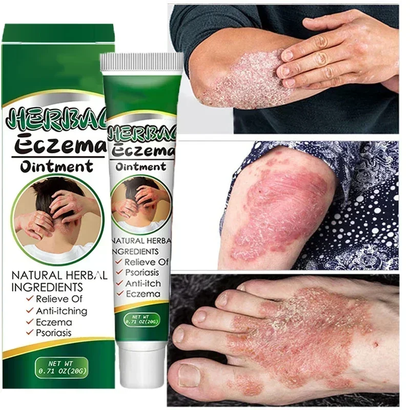 

Skin Psoriasis Eczma Itchy Herbal Cream for All Kinds of Skin herb Problems Chinese Herbal Antibacterial Ointment