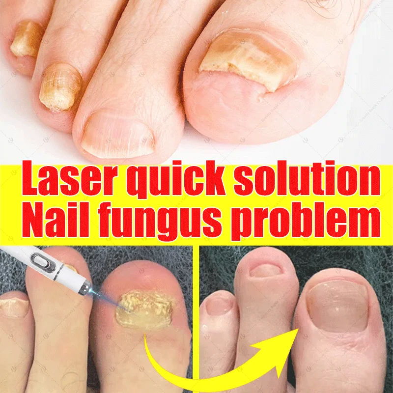 

laser machine for nail fungus