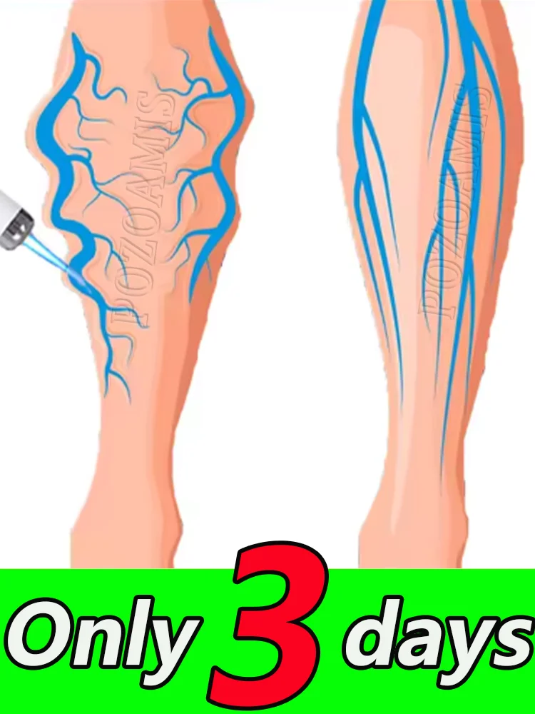 Leg vein repair light, leg vein patch, deformed and damaged, body care, 2025