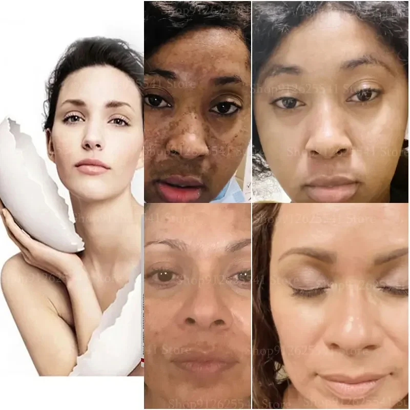 Niacinamide Skin Whitening Day Cream Remove Melasma Acne Spot Pigment Melanin Dark Spots Pigmentation Whitening Cream