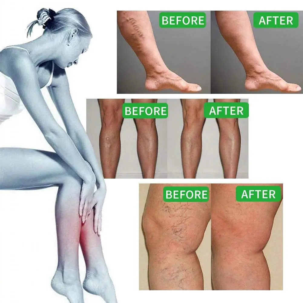 2023 Latest Varicose Pain Treatment Phlebitis Vasculitis Rotten Leg Spider Leg Treatment Cream face creams for women