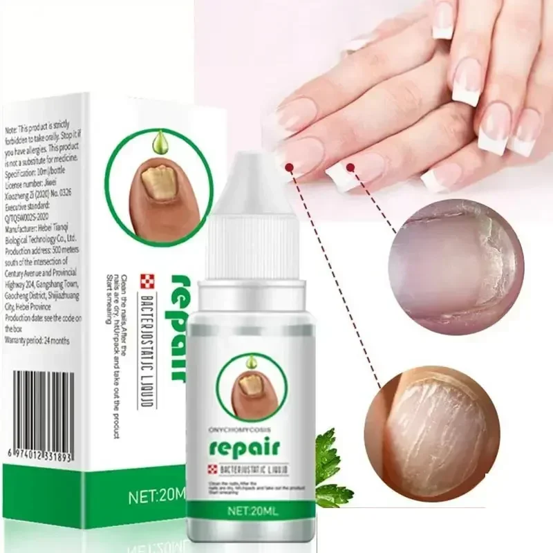 

Nail Fungus Treatment Serum Toe Fungal Repair Products Hand Foot Care Removal Gel Anti Infection Onychomycosis Paronychia