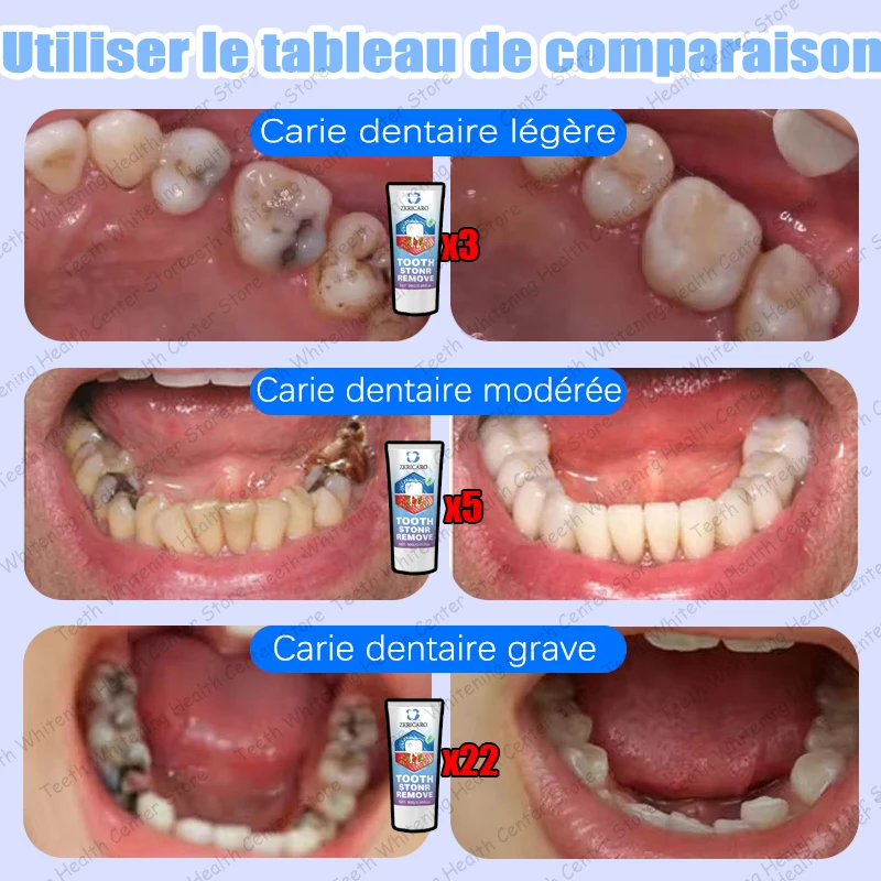 Vendita calda, necessità di molte persone, ripara la carie dei denti e mantiene i denti sani 2026