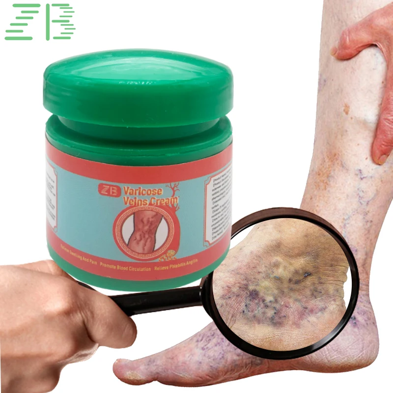 20g Varicose Veins Relief Ointment Effective Relieve Vasculitis Phlebitis Spider Pain Treat Cream Improves Circulation Body Care